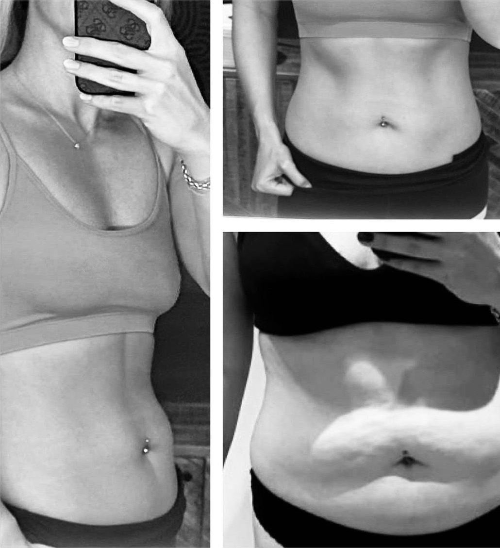 Bauch einer Kundin vorher und nachher im Vergleich